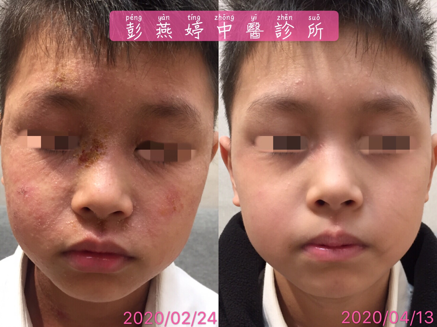 孩童異位性皮膚炎臉部治療成果